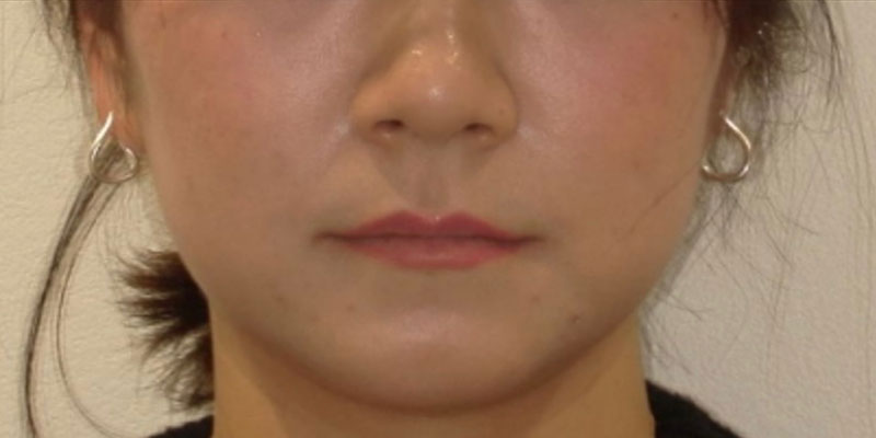 ボツラックス 治療後