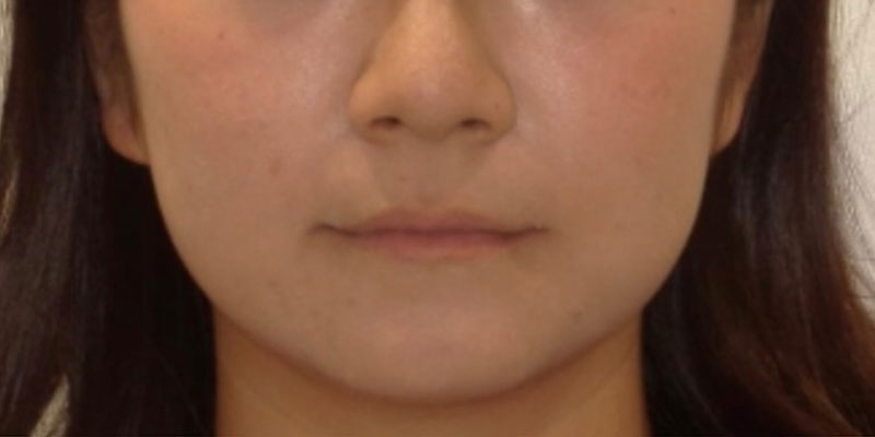 ボツラックス 治療前