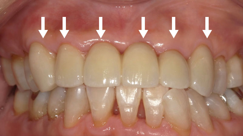 セラミック治療 治療後