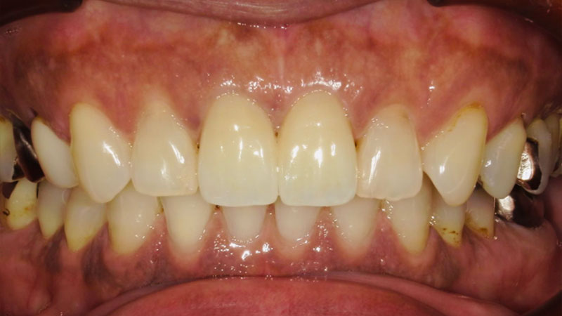 セラミック治療 治療後