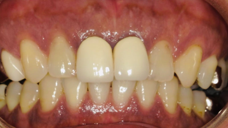 セラミック治療 治療前