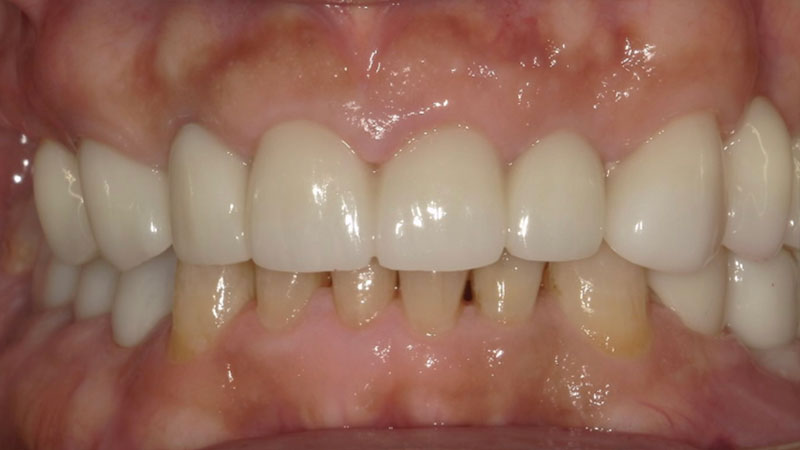 セラミックブリッジによる前歯の審美回復 治療後