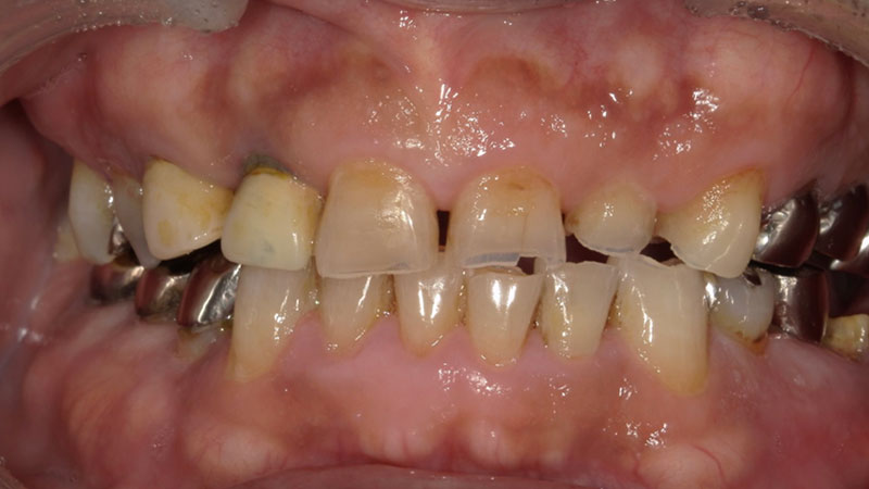 セラミックブリッジによる前歯の審美回復 治療前