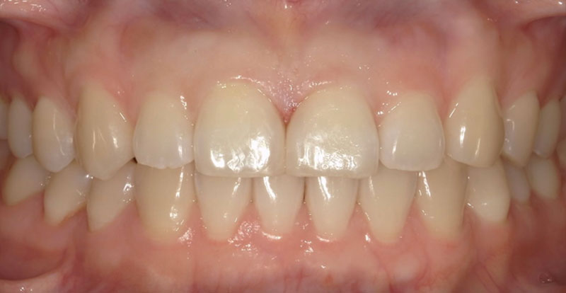 ダイレクトボンディング 治療後