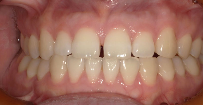 ダイレクトボンディング 治療前