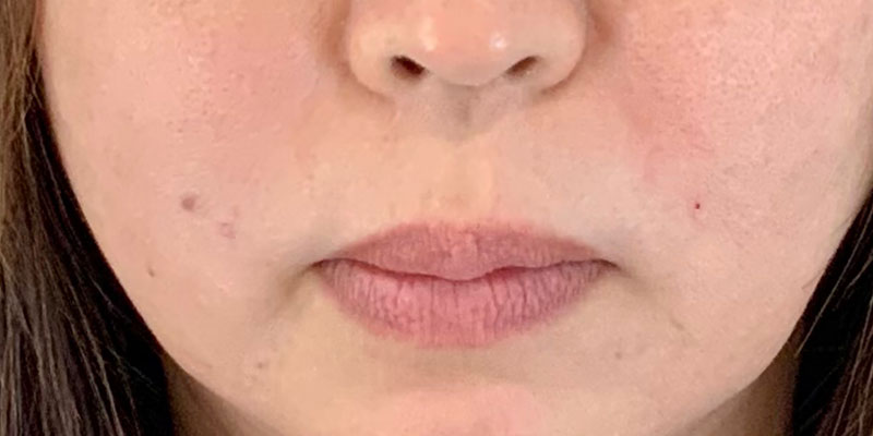 ヒアルロン酸療法 治療後