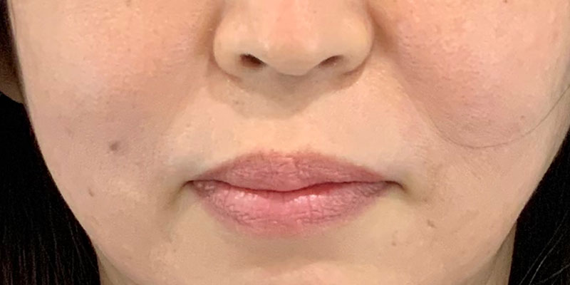 ヒアルロン酸療法 治療前