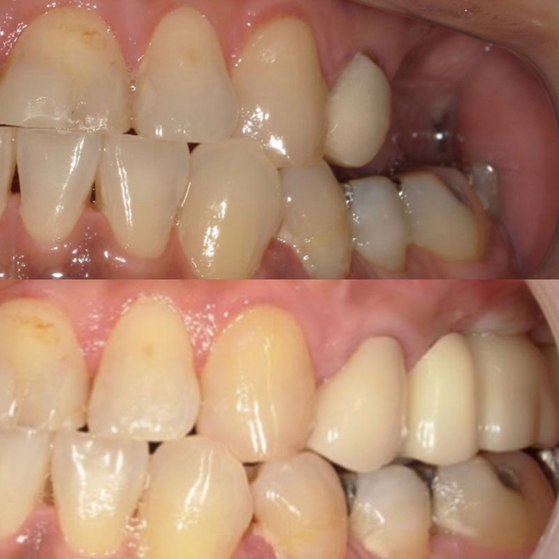 インプラント 治療前後の比較