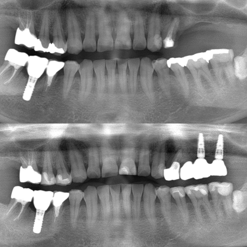 インプラント 治療前後のレントゲン