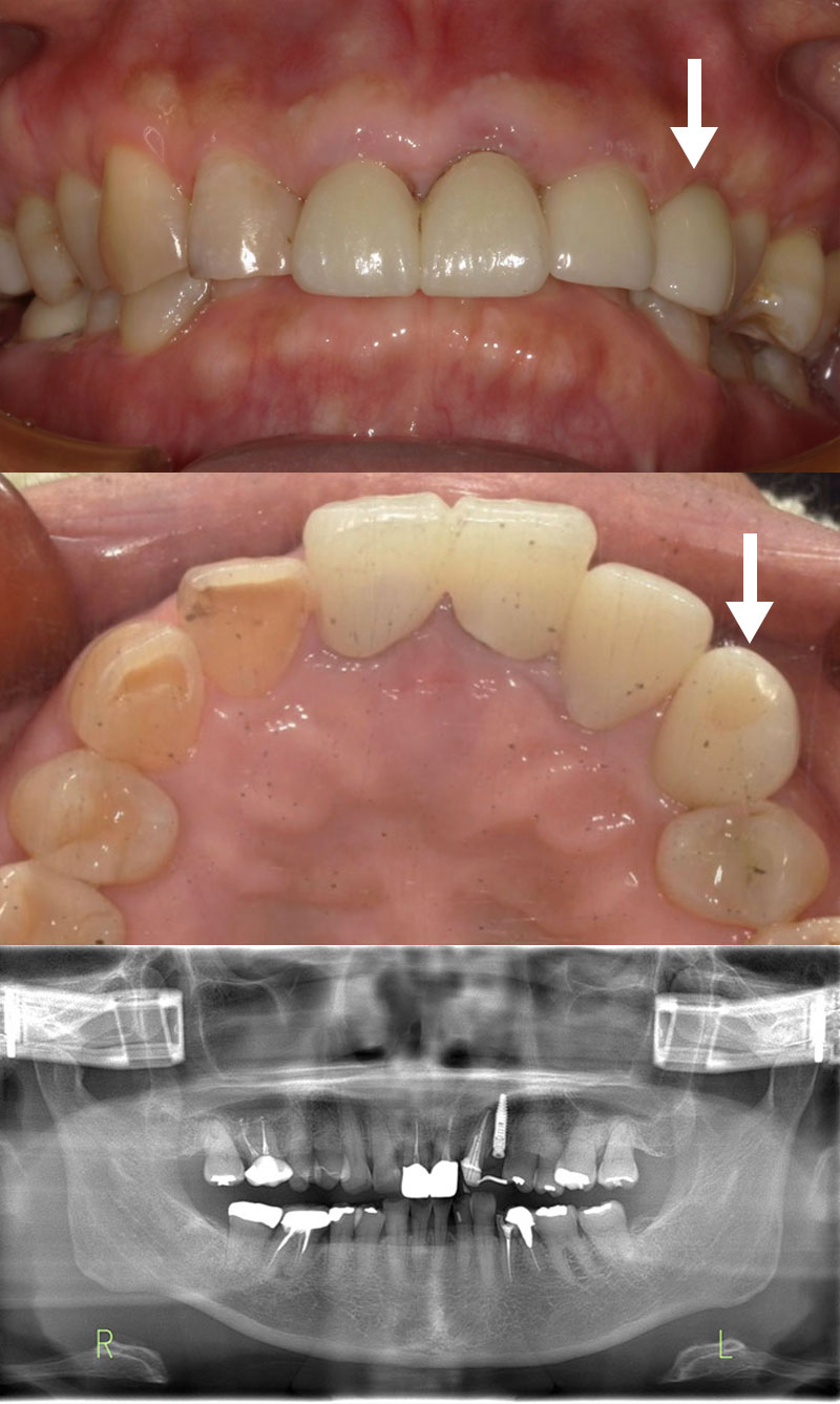 インプラント 治療後