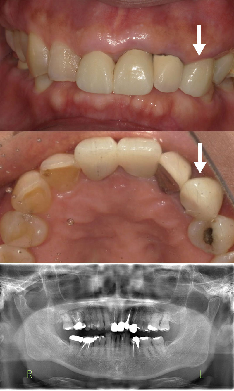 インプラント 治療前