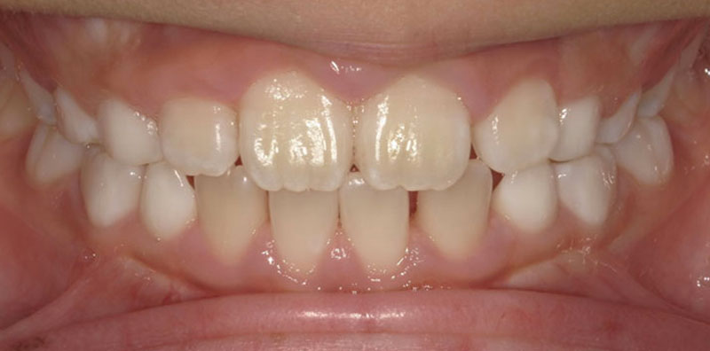 小児矯正 治療後