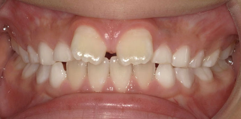 小児矯正 治療前