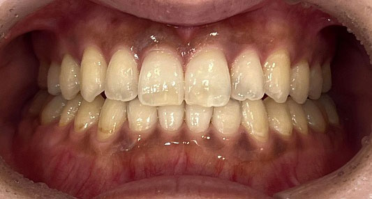 受け口の矯正 治療後