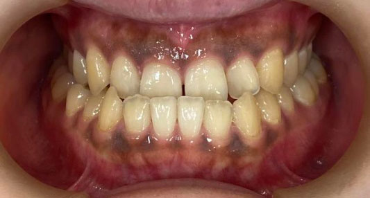 受け口の矯正 治療前