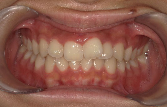 インビザライン(成人式に向けた短期矯正) 治療前