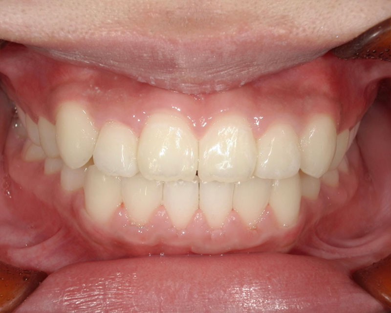 部分矯正 治療後