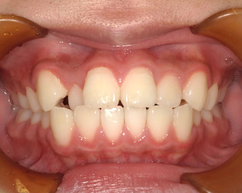 部分矯正 治療前