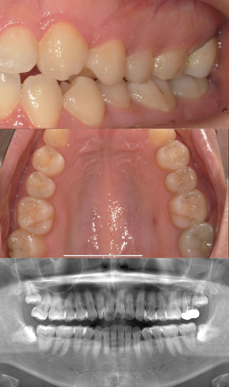 部分矯正 治療後