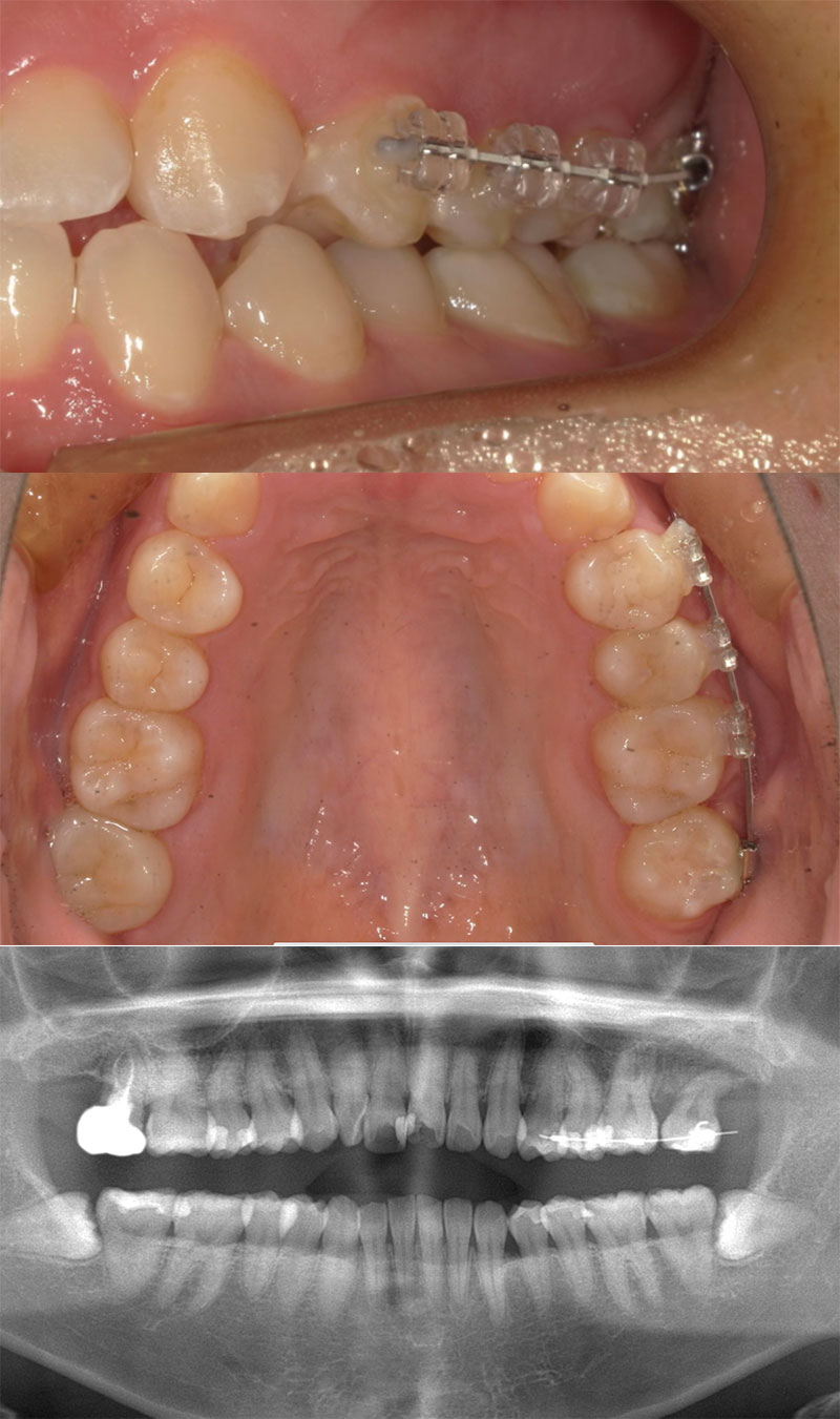 部分矯正 治療前
