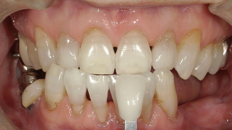 ホワイトニング 治療後