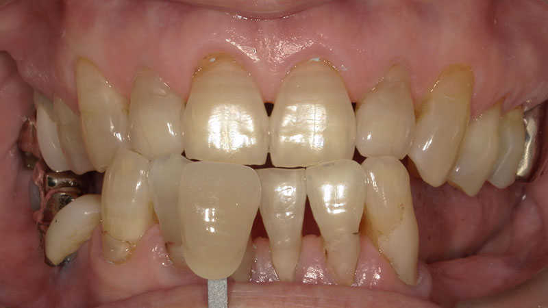 ホワイトニング 治療前