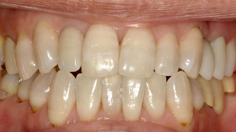 ホワイトニング 治療後