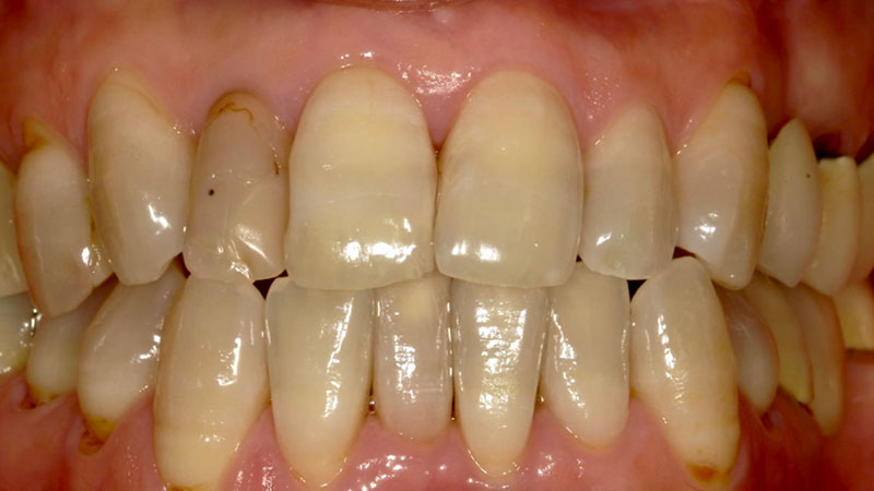 ホワイトニング 治療前