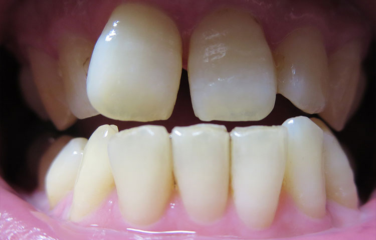矯正治療・ダイレクトボンディング・セラミックで理想の笑顔へ