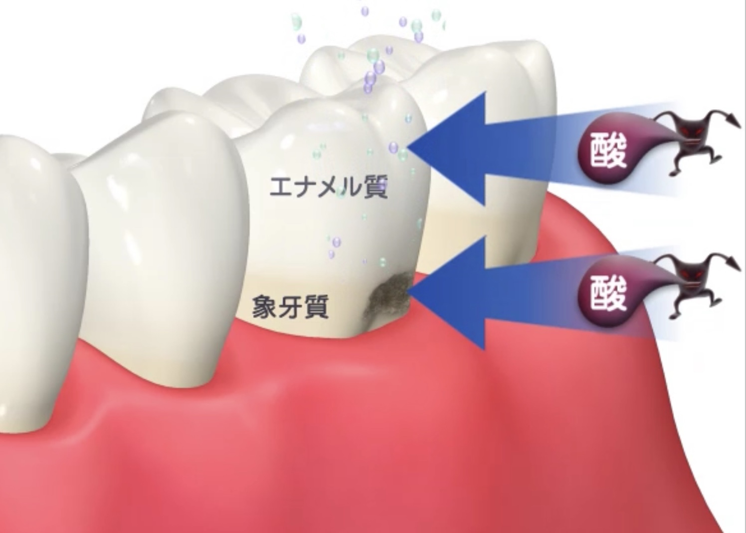 エナメル質・象牙質・補綴物のプロフェッショナルケア : 歯面研磨から歯面修復へ… エナメル質・象牙質・補綴物のプロフェッショナルケア2: [歯面