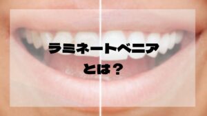 ラミネートベニア