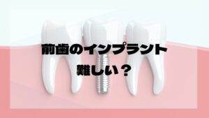 前歯のインプラント