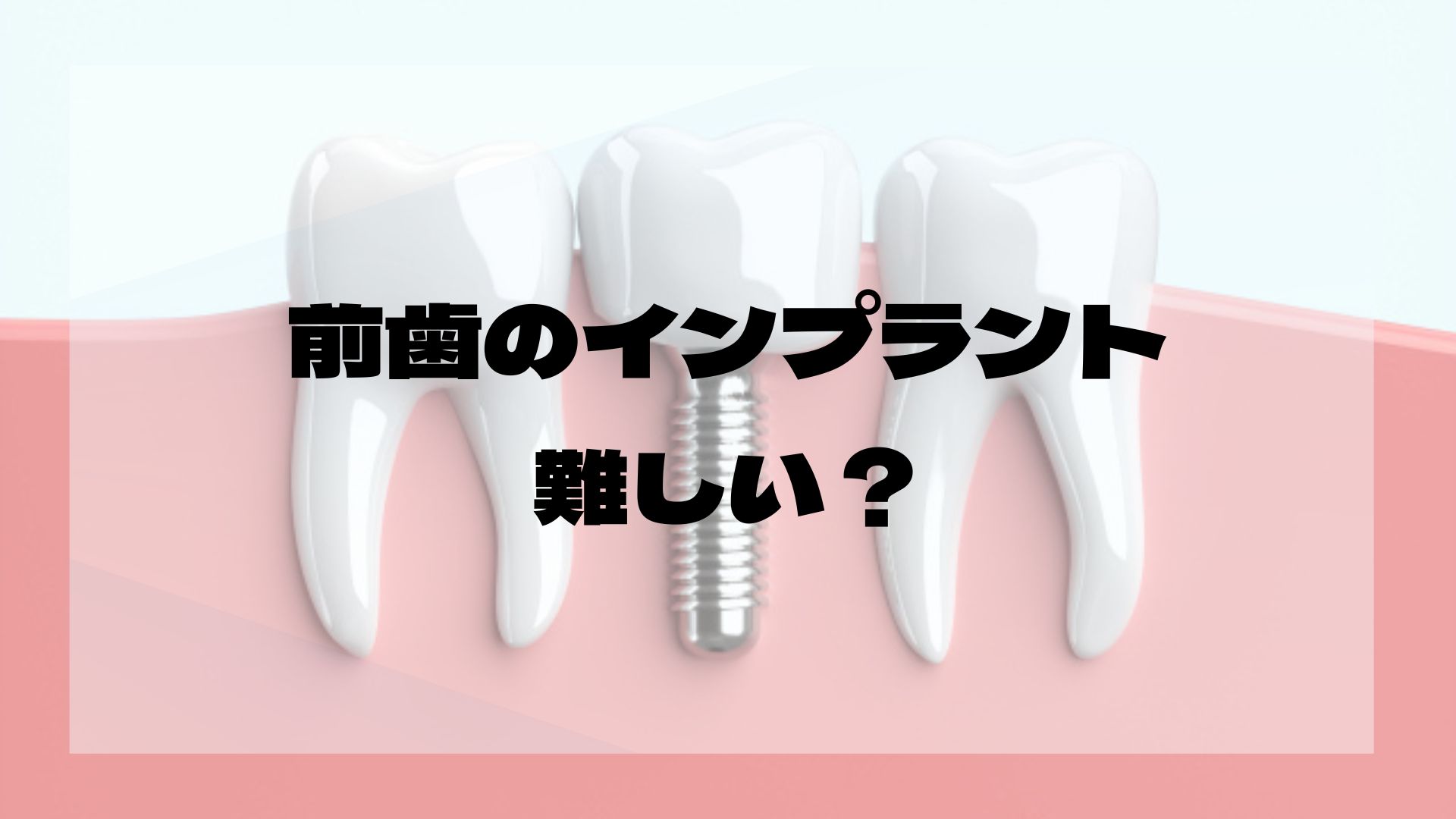 前歯のインプラント - 箕面市の歯医者「うえさか歯科」。桜井駅徒歩7分