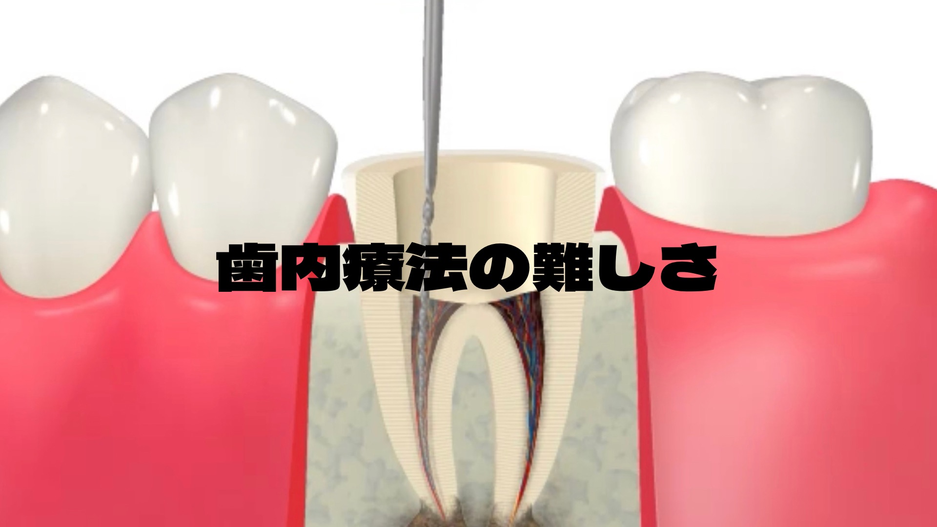 歯内療法（根管治療）の難しさ - 箕面市の歯医者「うえさか歯科