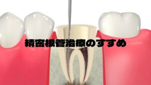 根管治療
