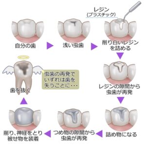 レストレーションサイクル