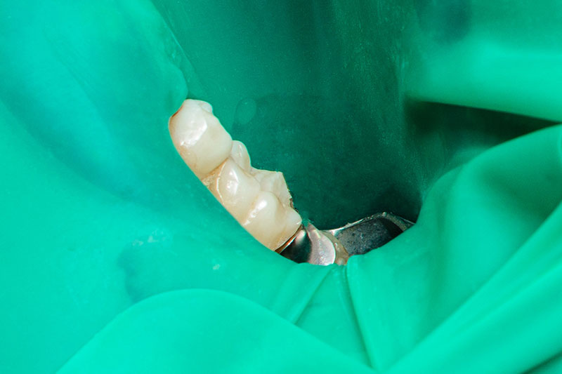 ラバーダム防湿による無菌状態の保持