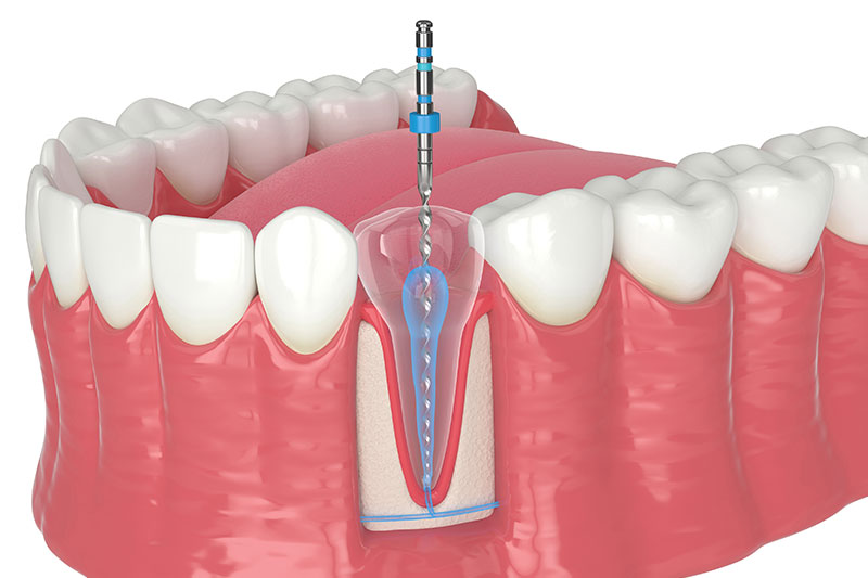 ニッケルチタンファイル