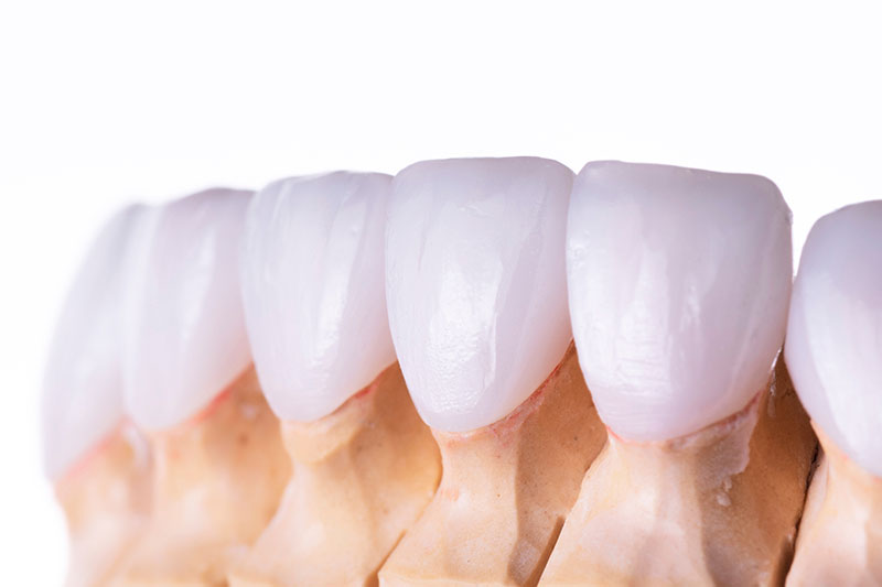 根管治療における被せ物の重要性