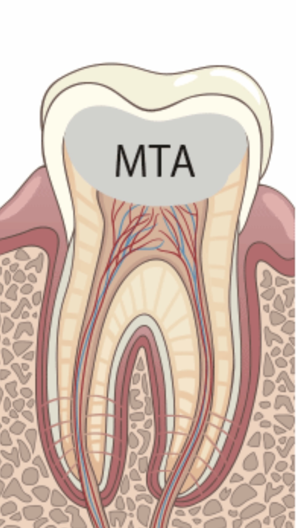 歯髄温存療法のすすめ - 箕面市の歯医者「うえさか歯科」。桜井駅徒歩7