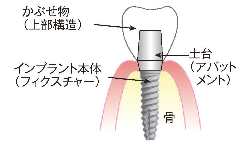 インプラント治療