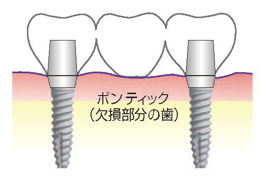 インプラント治療