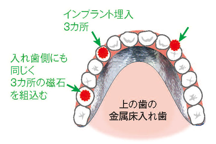 インプラント治療