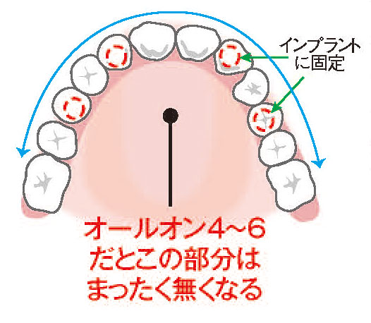 インプラント治療