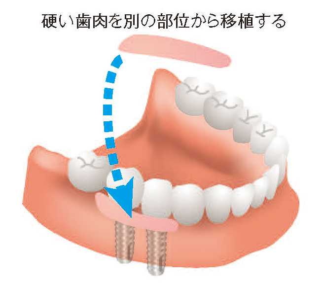 インプラント治療