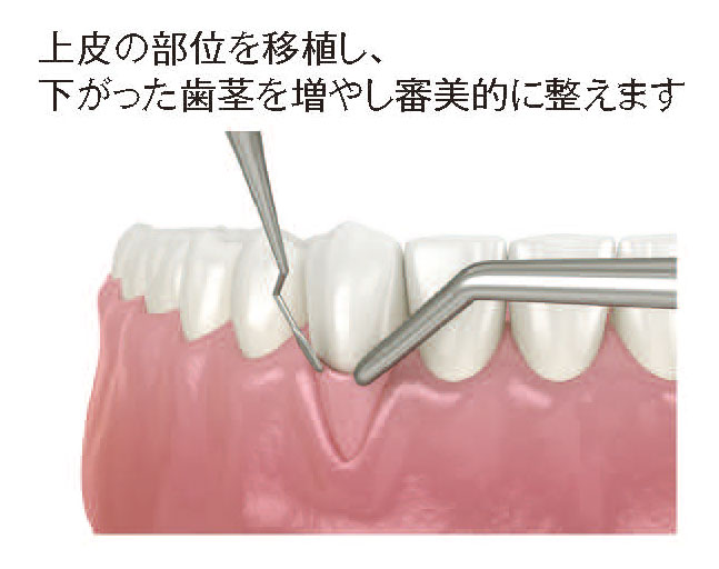 インプラント治療