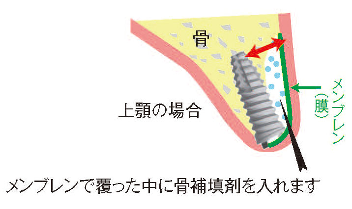 インプラント治療