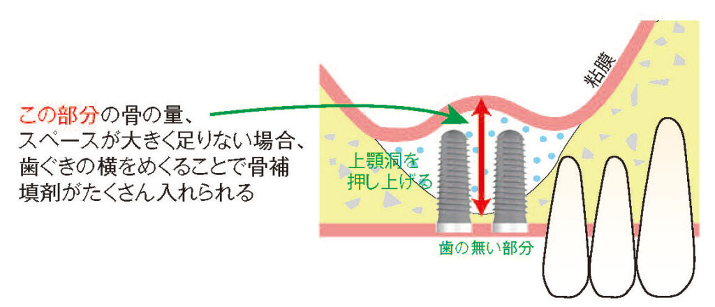 サイナスリフトによる骨造成の説明図