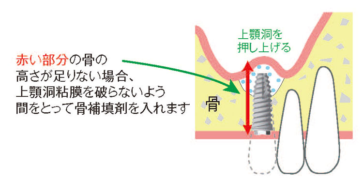 インプラント治療
