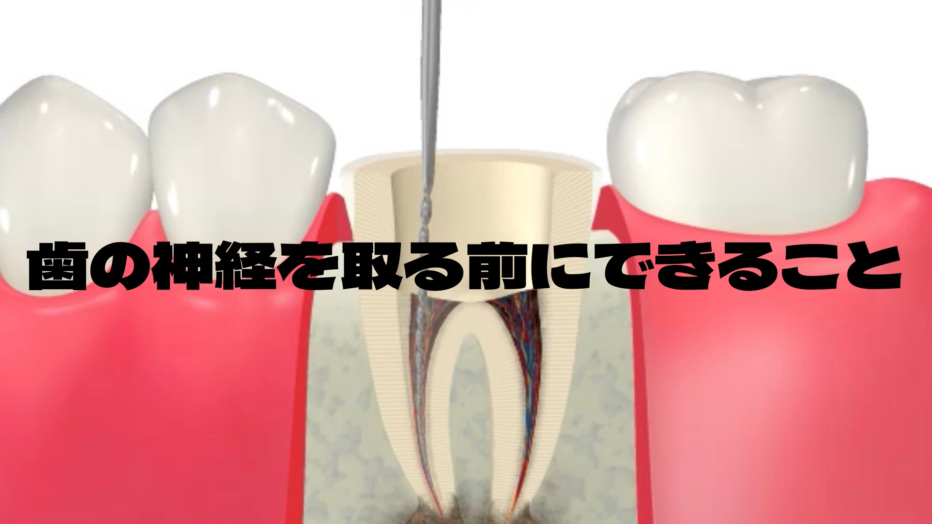 歯の神経を取る前にすべきこと - 箕面市の歯医者「医療法人うえさか